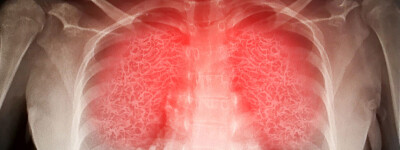 Исследование – повреждение легких сохраняется через год после перенесенной пневмонии Covid
